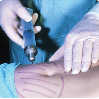 liposukcija