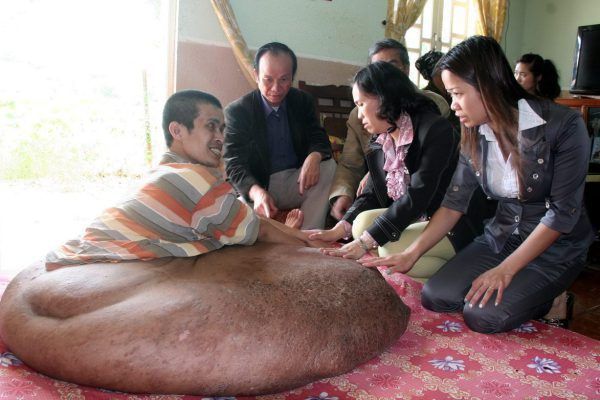 Tumor od 80 kg