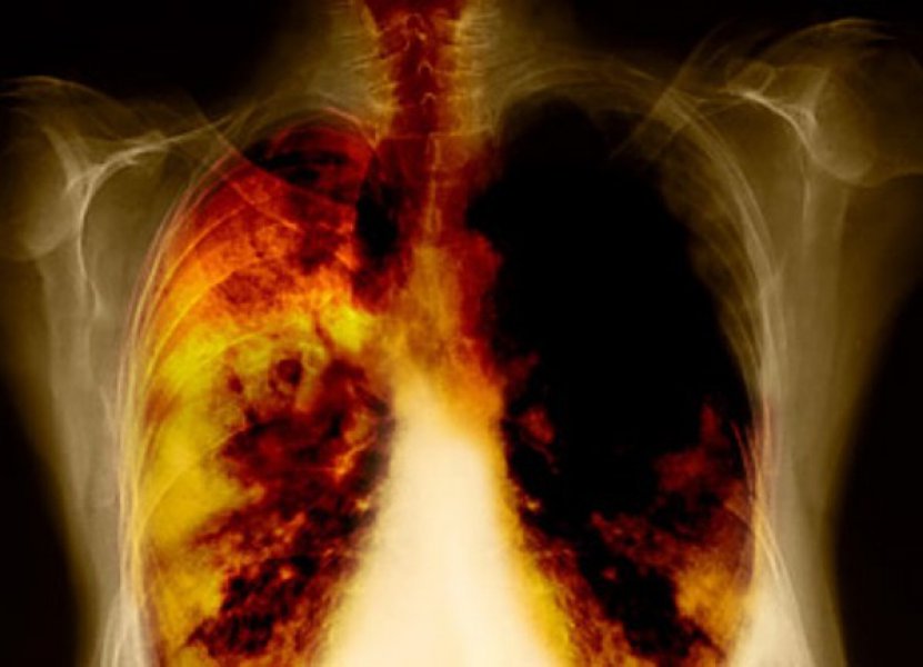 rak pluća