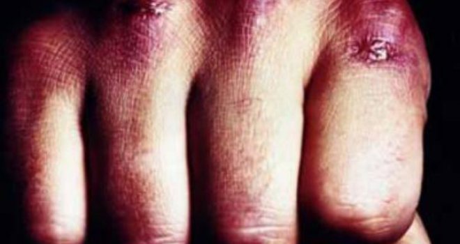 'Ja se nikome ne sklanjam': Pretukli ga iz obijesti, polomili mu zube... jer ih je autom pretekao na cesti!