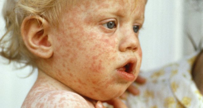  Mostaru i HNK-u prijeti epidemija morbila! Upućen apel roditeljima da obvezno vakcinišu djecu