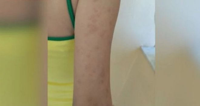 Djecu u ljetnom kampu unakazile stjenice: Kćerka joj završila sa plikovima od glave do pete, a tek u koferu - horor!